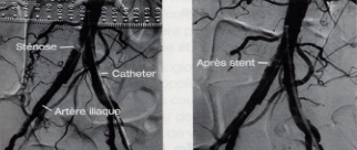 Angioplastie