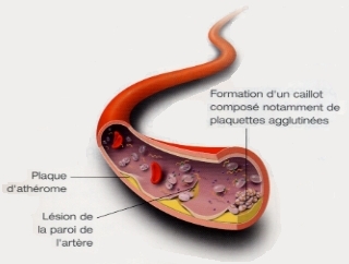 Atherothrombose