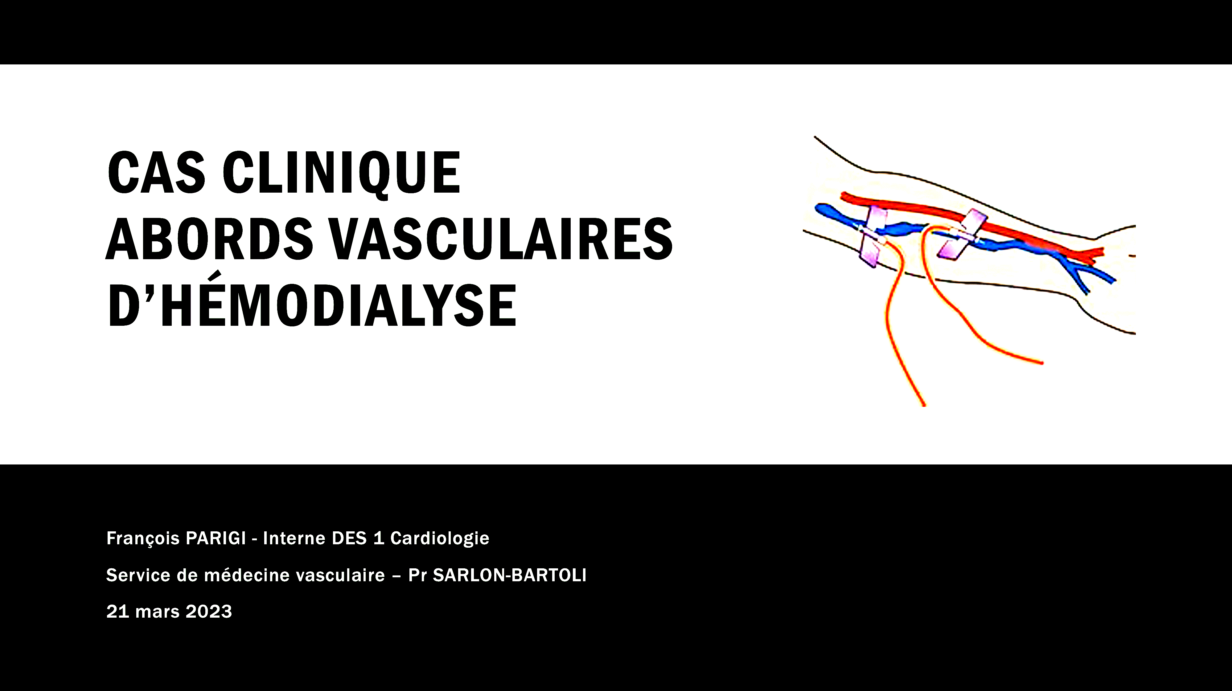 Thrombose Fistule artério-Veineuse