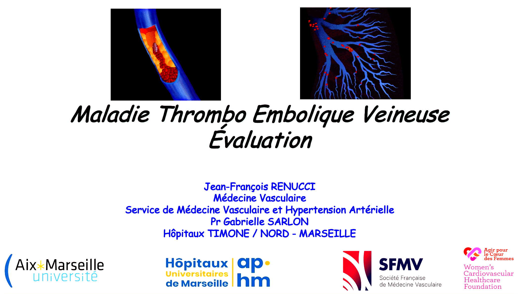 Dr RENUCCI - Maladie Thombo Embolique Veineuse MTEV Evaluation