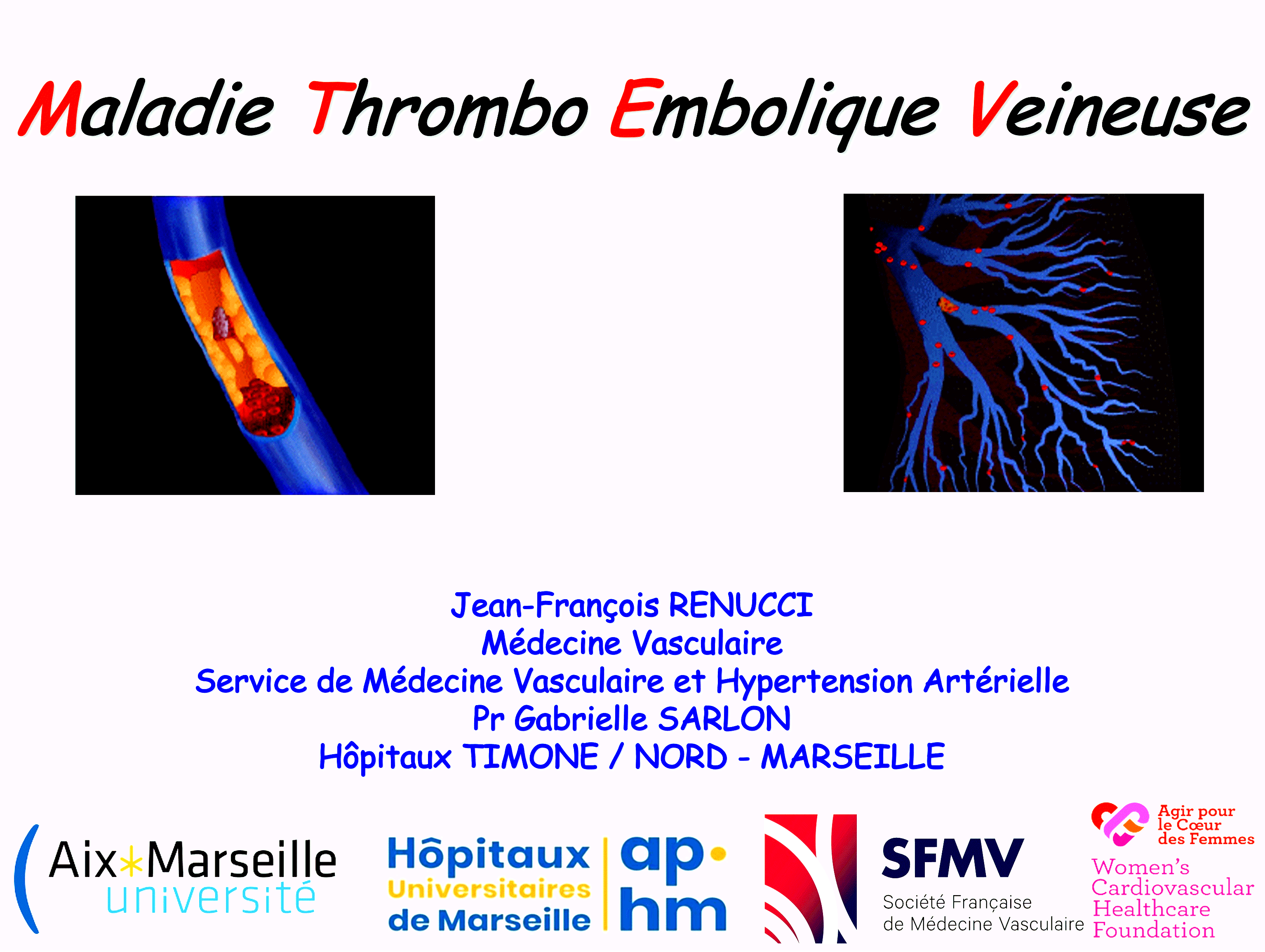 Dr RENUCCI - Maladie Thombo Embolique Veineuse MTEV